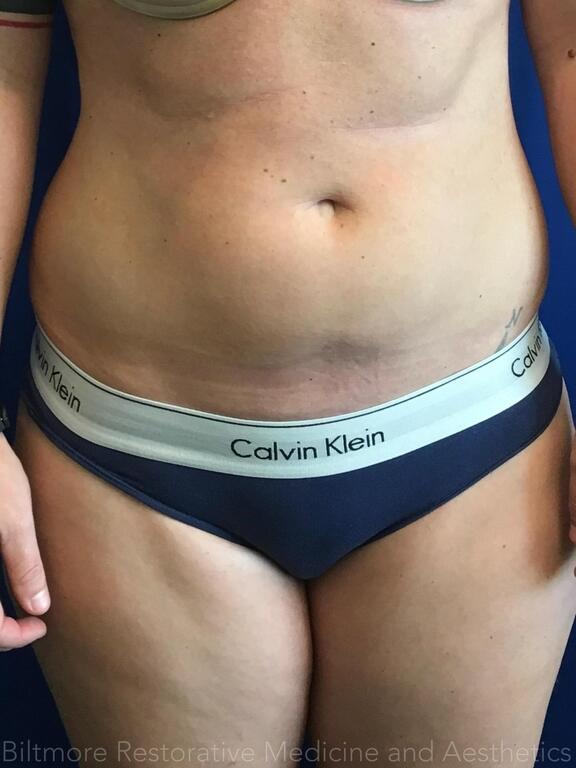 Woman before hormone and peptide therapy