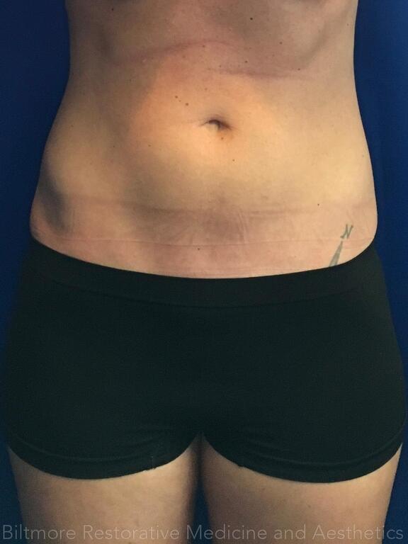 Woman after hormone and peptide therapy